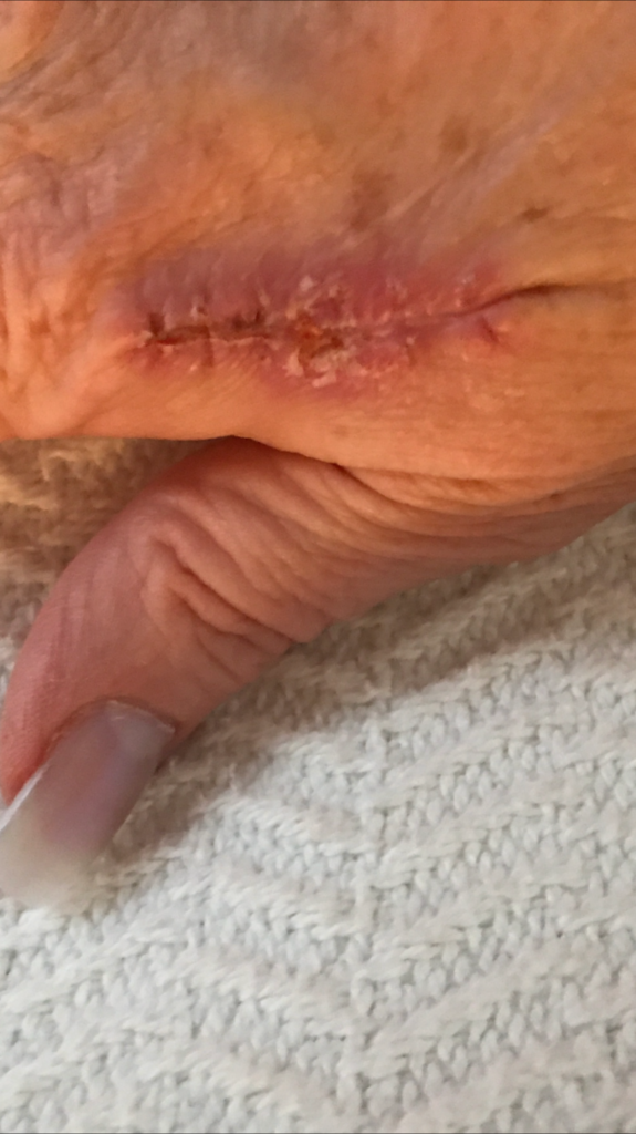 Wrist incision early in recovery before HAE Herbal Cream