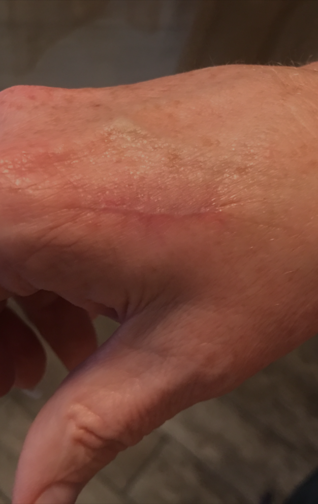 Wrist scar healed and faded after using HAE Herbal Cream